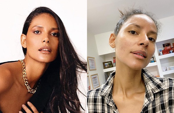  Como cuidar da pele com acne na vida adulta