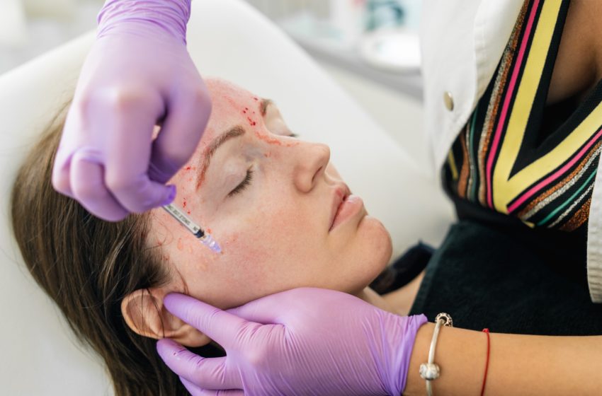  Vampire Facial: te contamos tudo sobre o procedimento estético