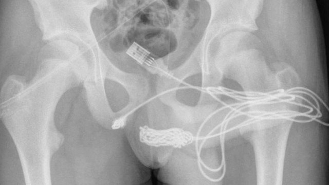  Adolescente passa por cirurgia após inserir cabo USB no pênis a fim de medir o órgão